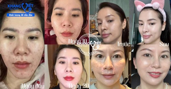 Viên uống đẹp da sâm tố nữ Collagen Puecolazen Kohinoor chính hãng – Bổ sung nội tiết tố nữ