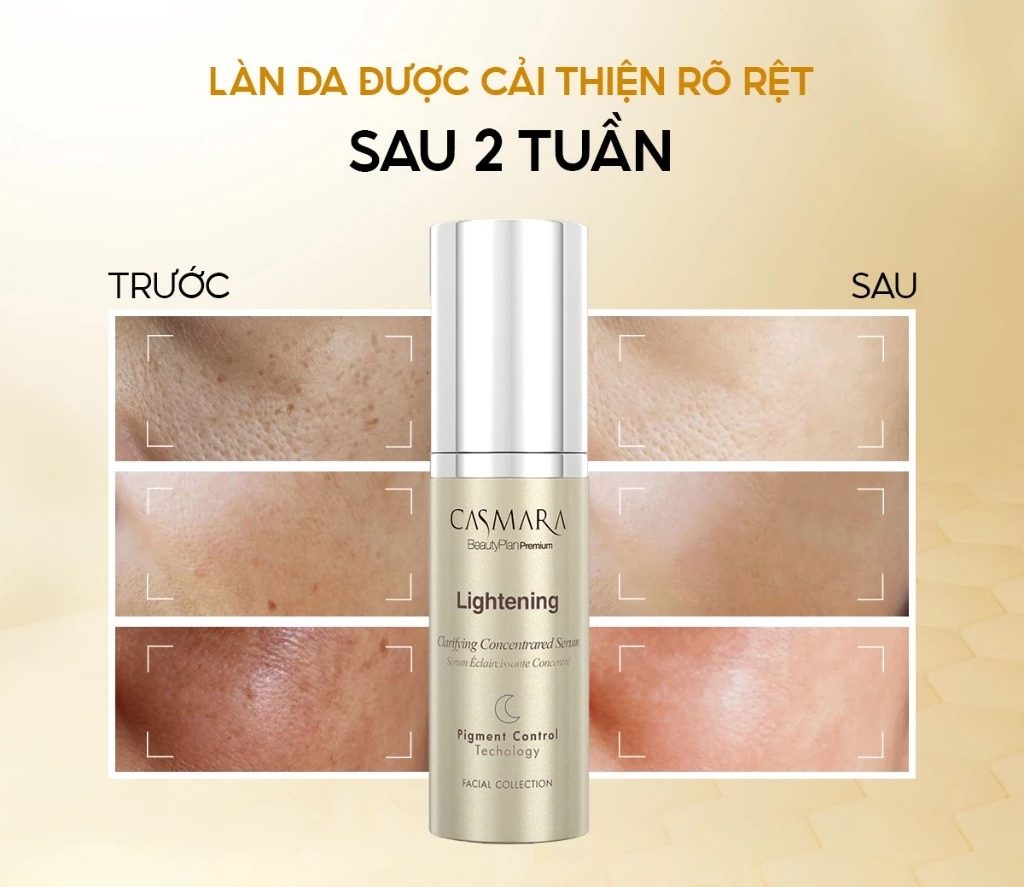 Serum Casmara Lightening Clarifying Concentrated 30ml cải thiện da Serum Casmara Lightening Clarifying Concentrated 30ml – Hỗ trợ làm sáng da, cân bằng dầu và cải thiện da mụn